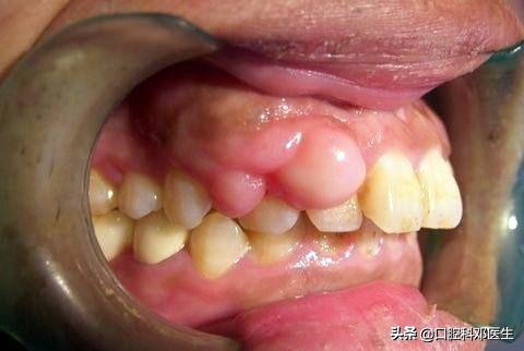 牙龈息肉症状图片