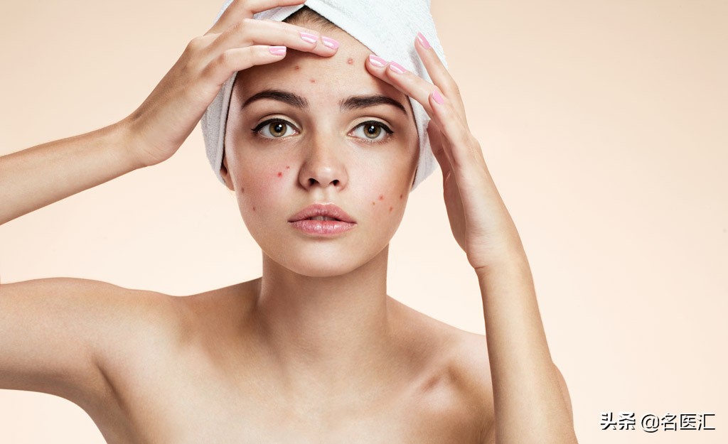 关于痘痘，你最想知道的几个问题（附答案）