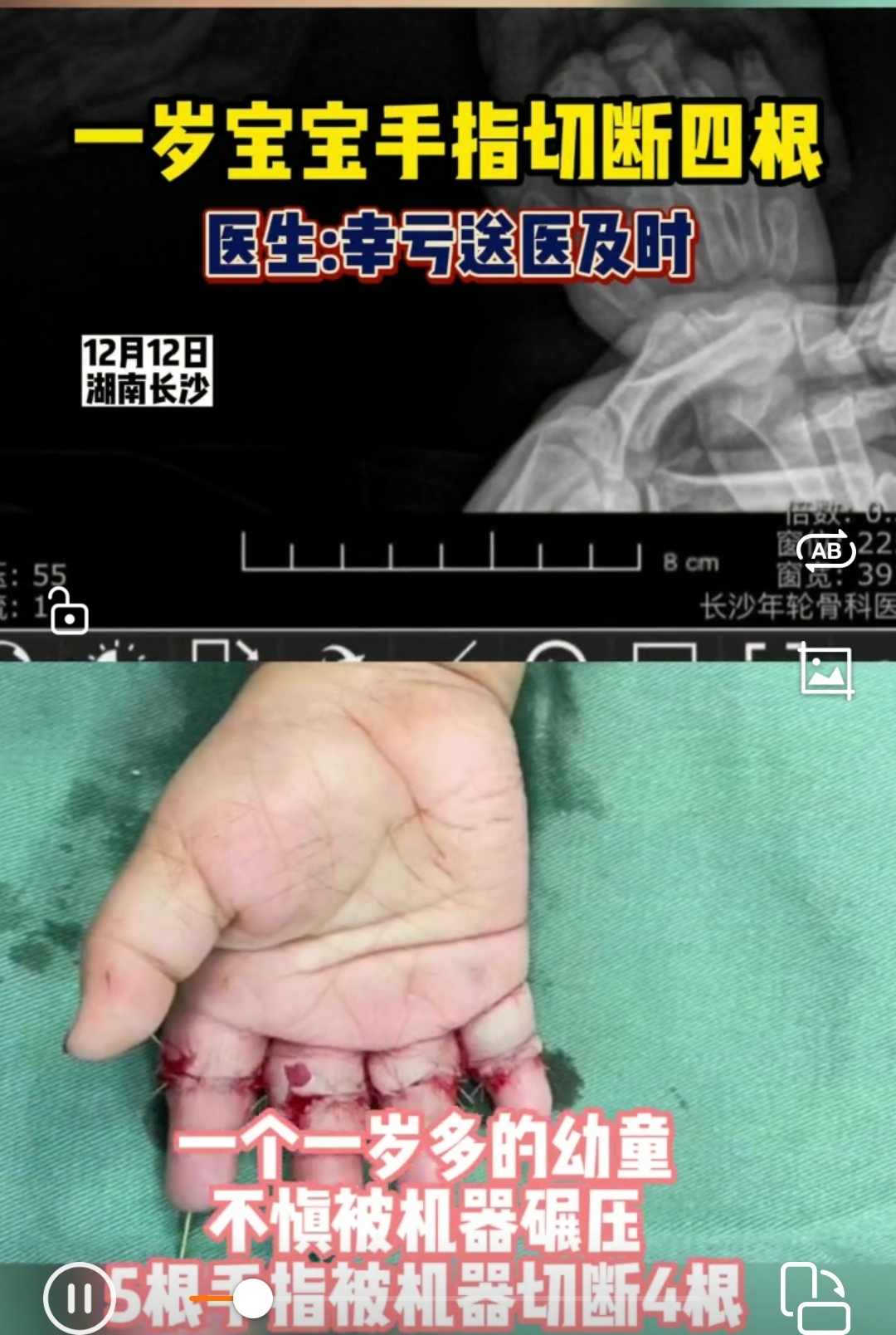 心痛！湖南长沙一岁宝宝手指切断四根，父亲开车超速行驶前往医院