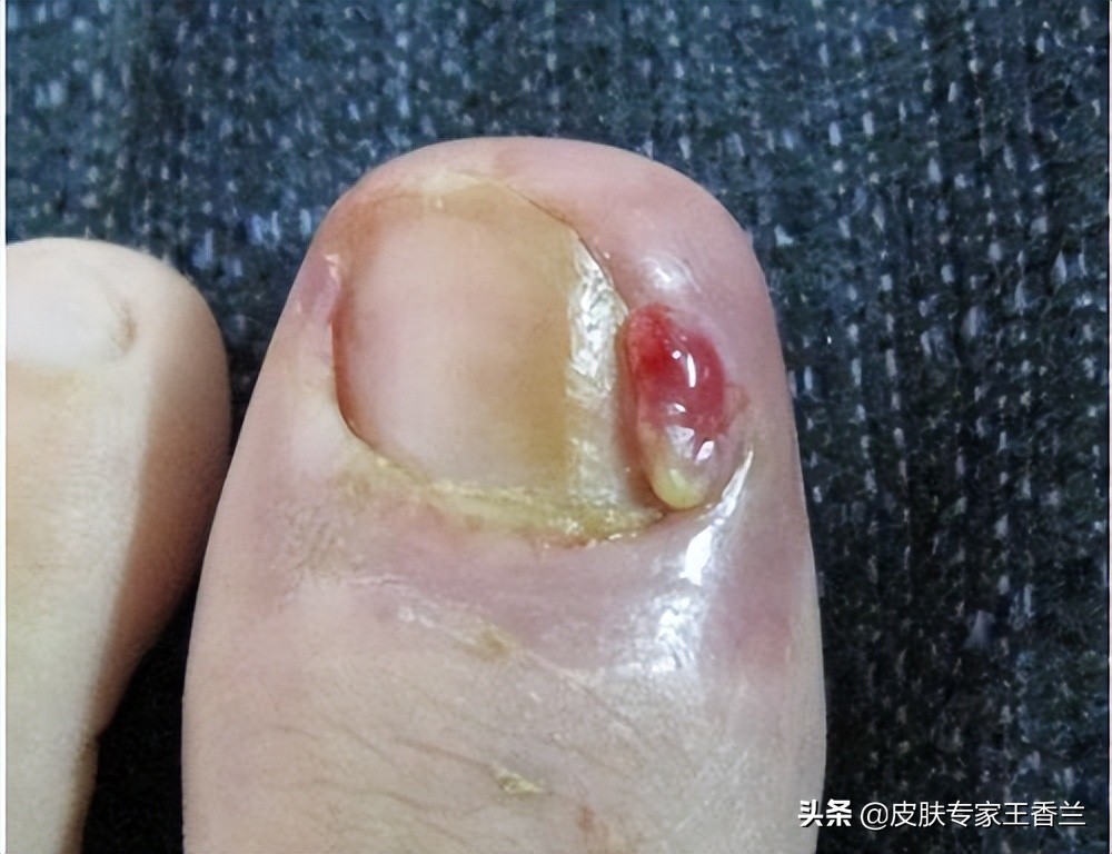 有的还会出现指甲变绿,指甲周围或甲下脓肿,局部感到疼痛